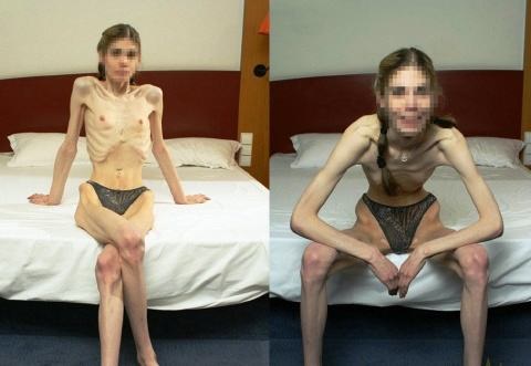 anorexia