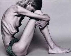 anorexia