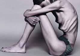 anorexia